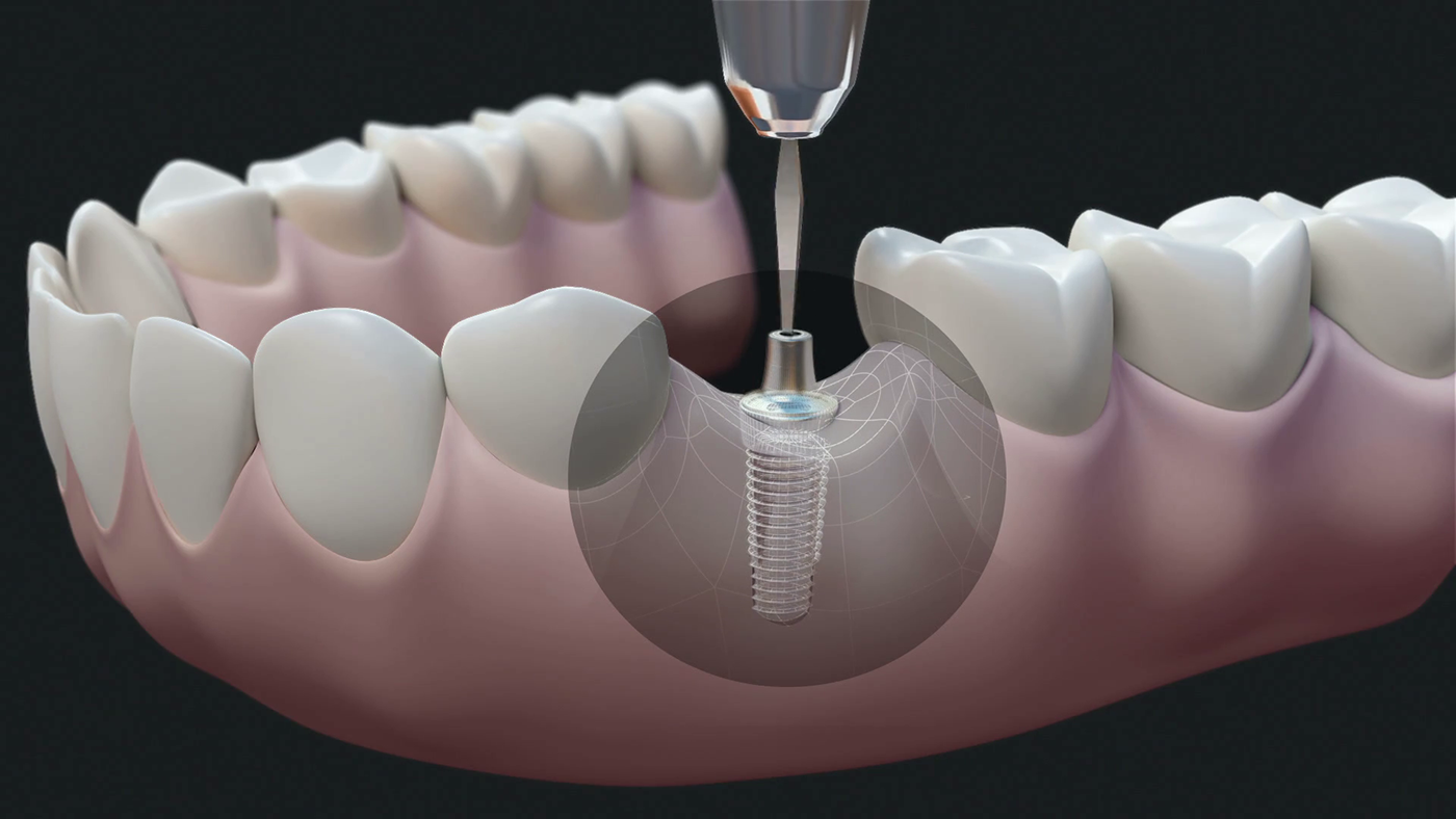 oral health dental care teeth gums Dental Implants Tooth loss teeth restoration