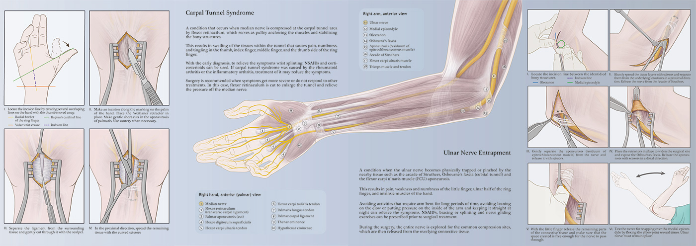 surgery medical illustration surgical instruments arm ulnar nerve release carpal tunnel release stitching technique step-by-step illustrations anatomy pocket boocklet