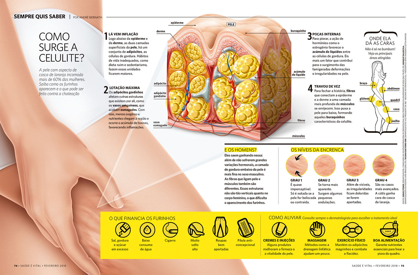 celulite pele Ilustração infografia