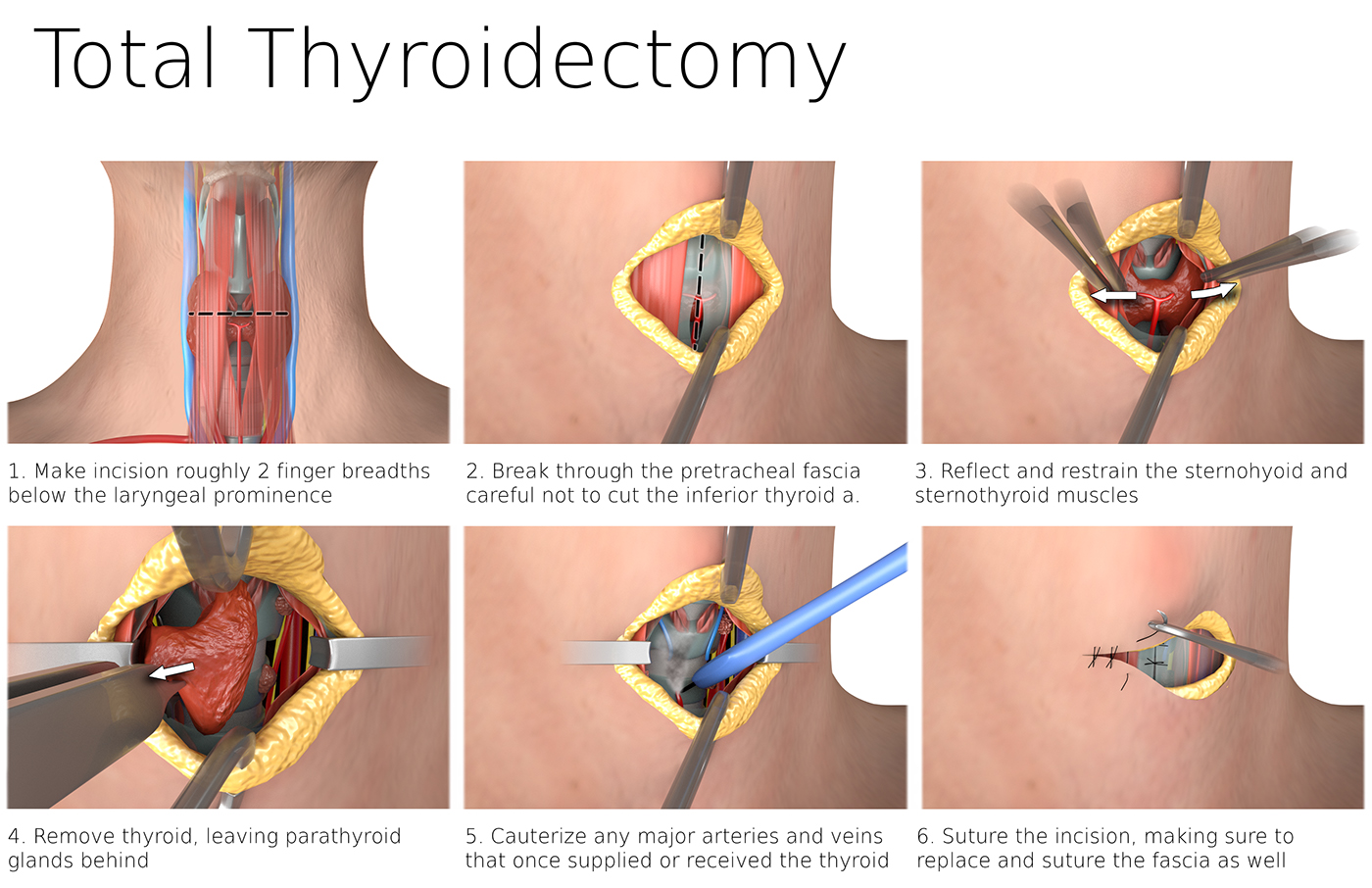 Maya medical illustration surgical surgery thyroidectomy 3D nissen fundoplication