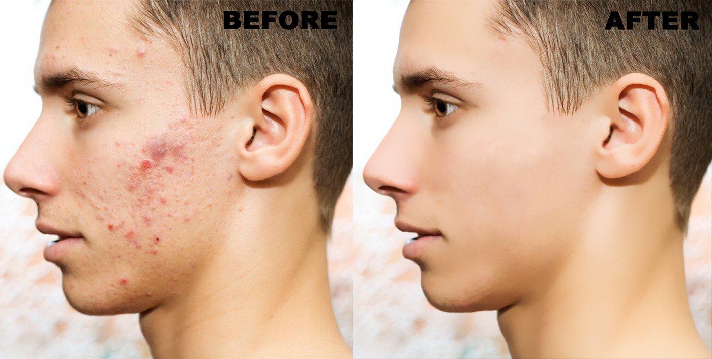 acnes blemishes Face Retouch photo enhance photo retouch removing wrinkeles whiten teeth