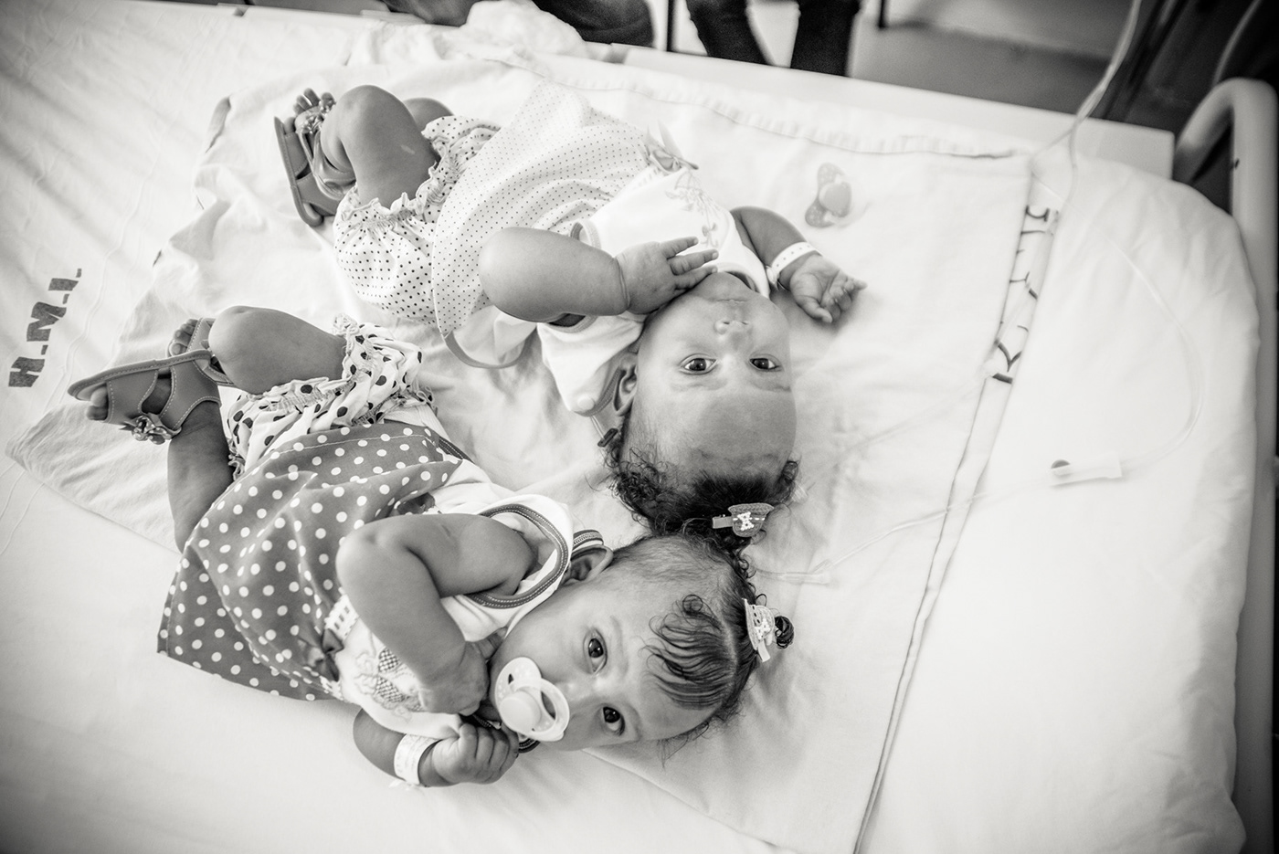 baby baby girl Brazil conjoined twins goiânia medic siamese Sisters surgery Twins
