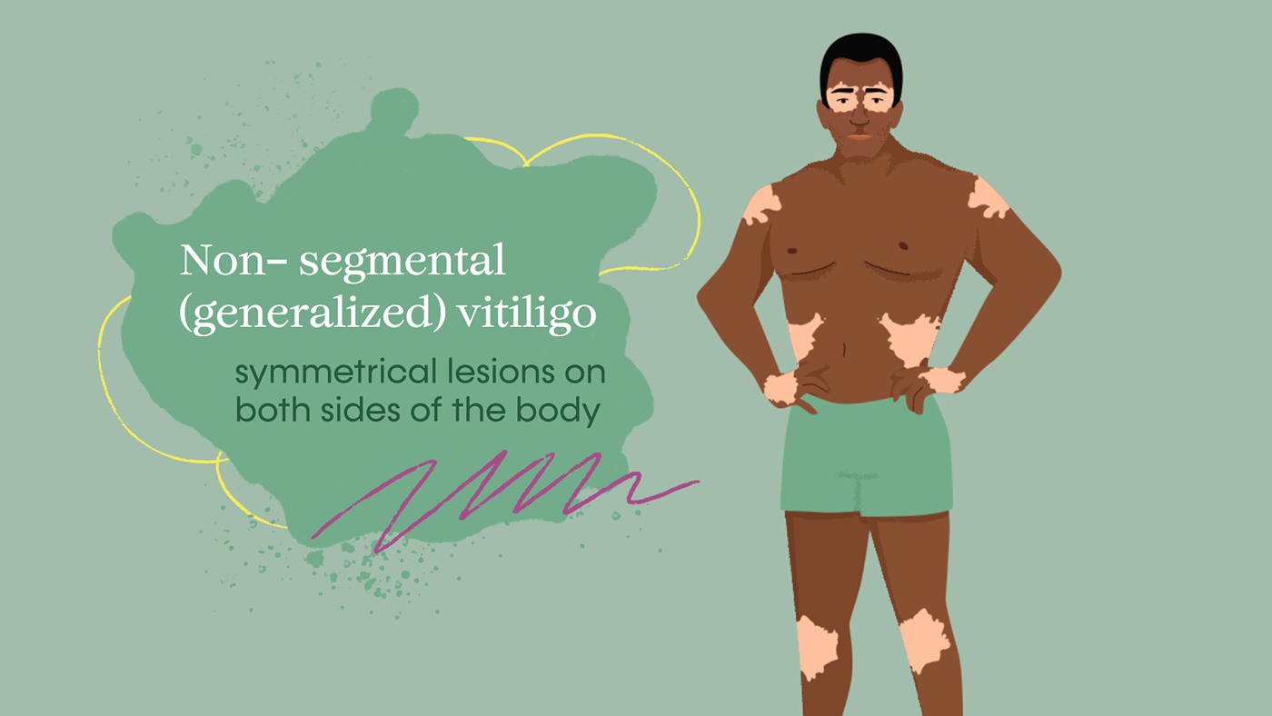 design Graphic Designer vitiligo medical Health skin 2D
