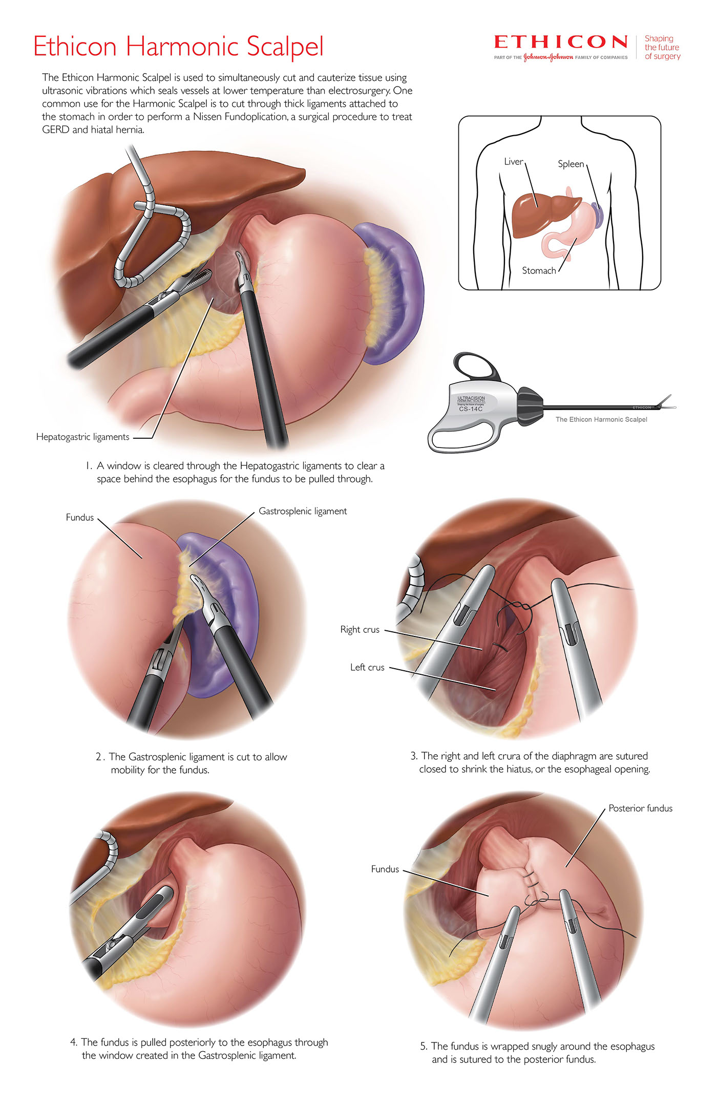 medical illustration biomedical illustration Surgical Illustration nissen fundoplication Promotional surgical poster surgery harmonic scalpel hiatal hernia gerd