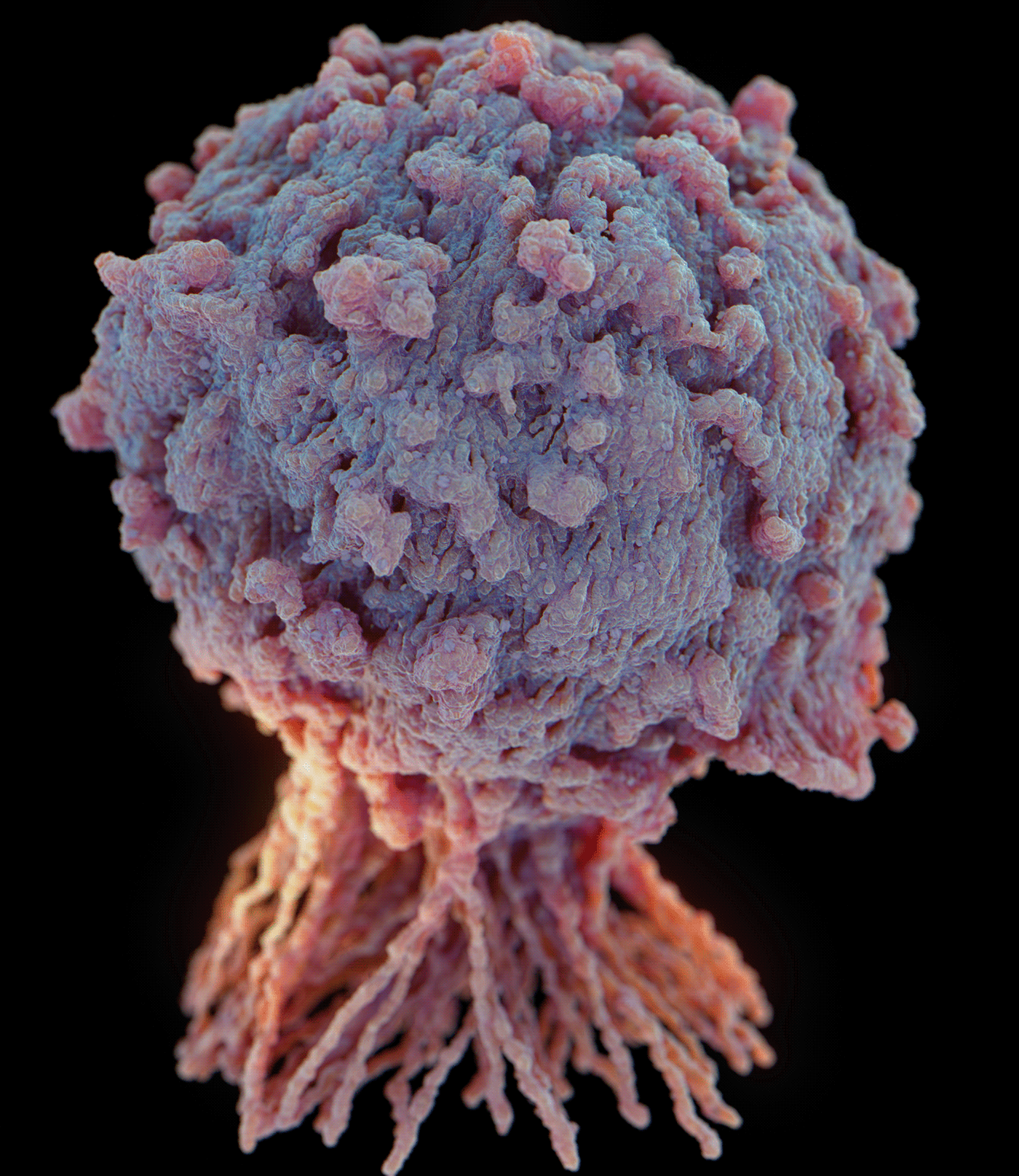 medical tumor tumor cell Tumor Cells