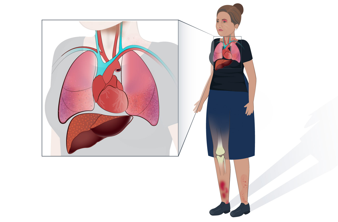 Medical Illustration of the Pathophysiology of Sarcoidosis
