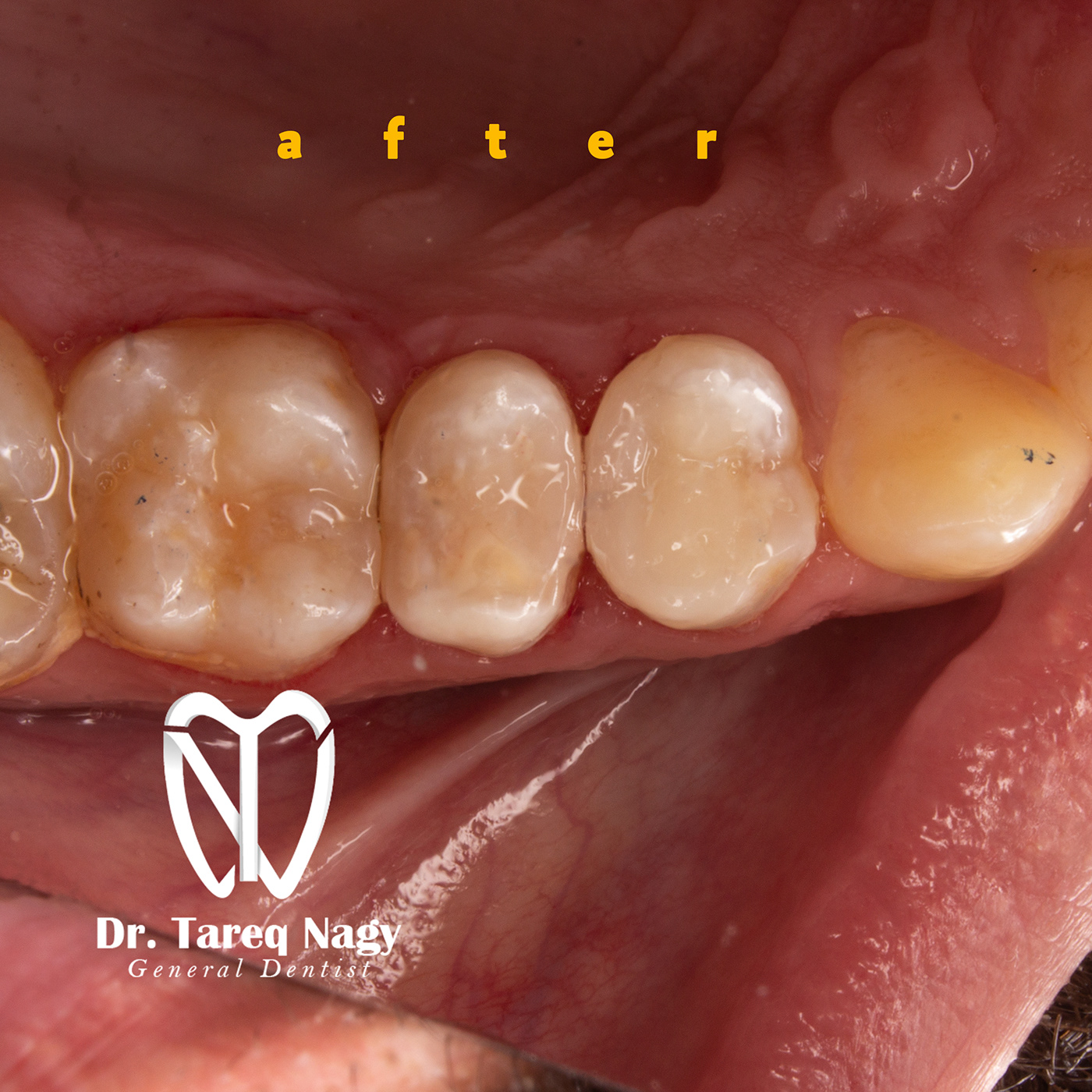 endodontics Composite Photography 