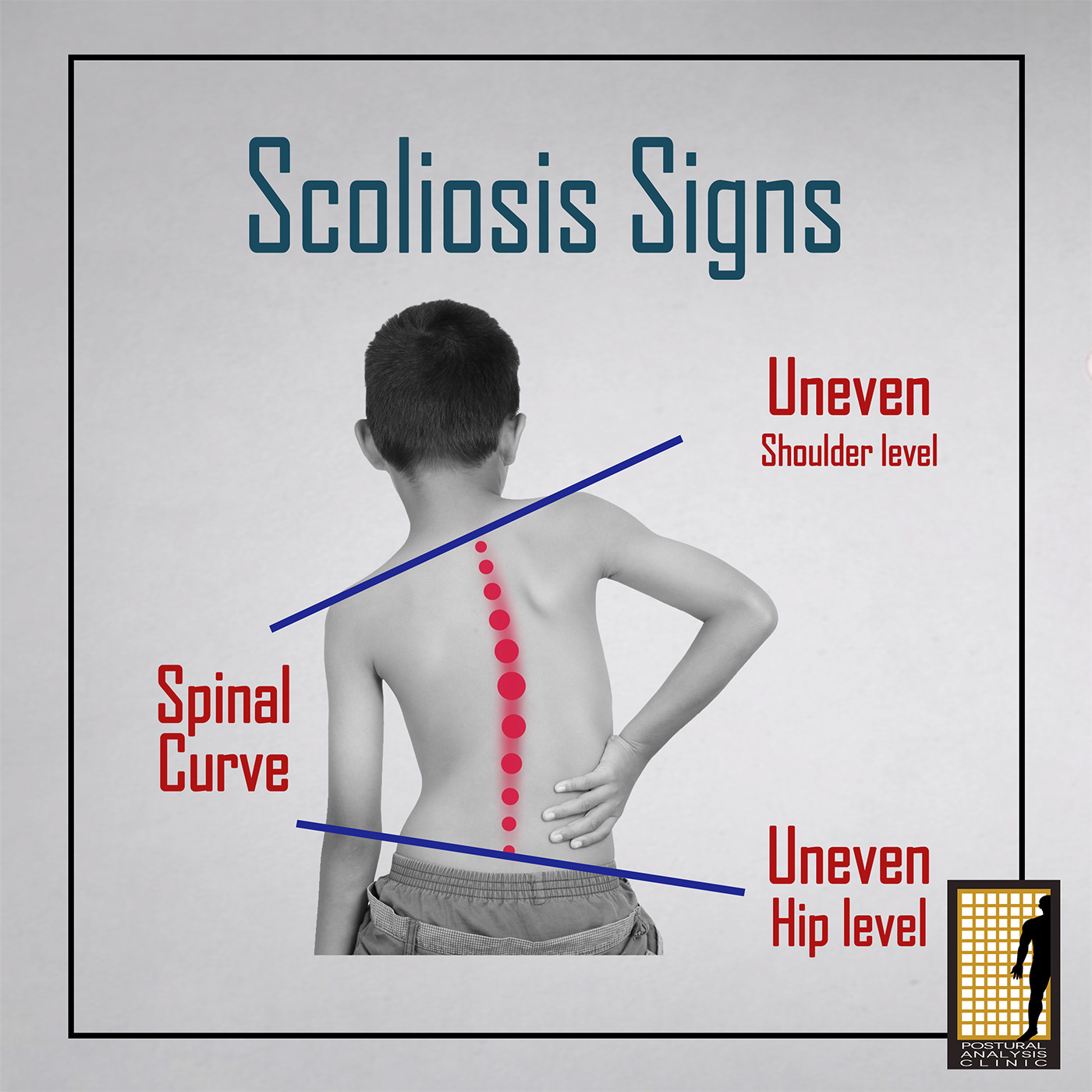 awareness body deformity Love medicine neck physicaltherapy Posture rehabilitation spine