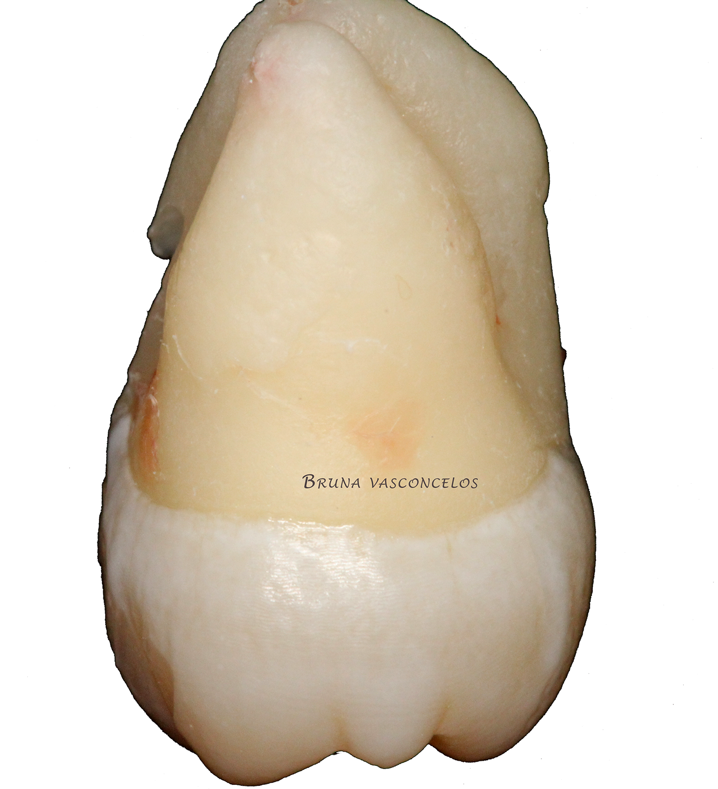 molar surgery oral photography dental anatomy third molar apical foramen periodontology endodontics dentistry oral medicine