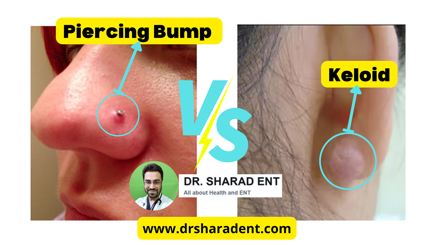 piercing Treatment medical ent keloid Keloid Scars Piercing bump