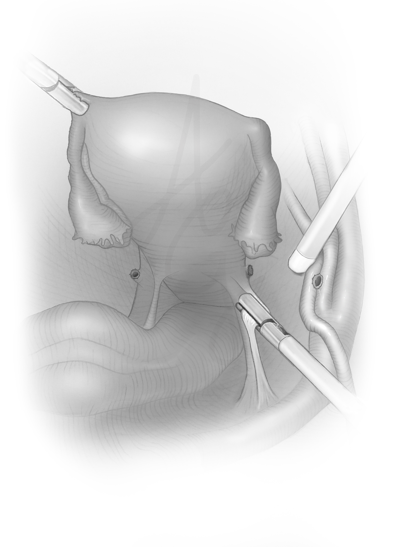 medical illustration Surgical Illustration hysterectomy uterus medical textbook