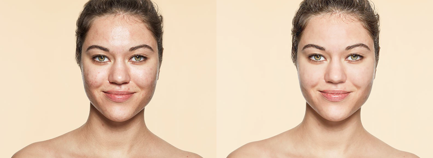 Skin Treatment tratamento de pele tratamento de imagem Manipulação de imagem edição de imagem moda retoques