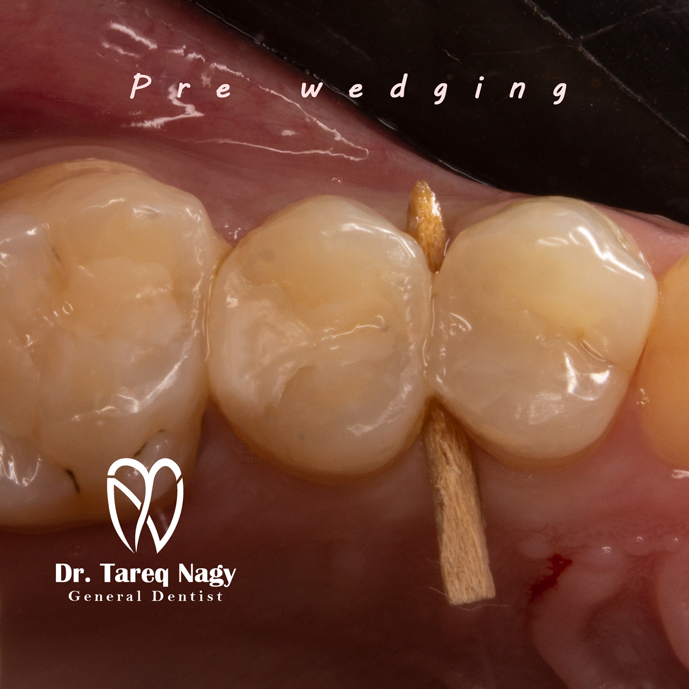 endodontics Composite Photography 