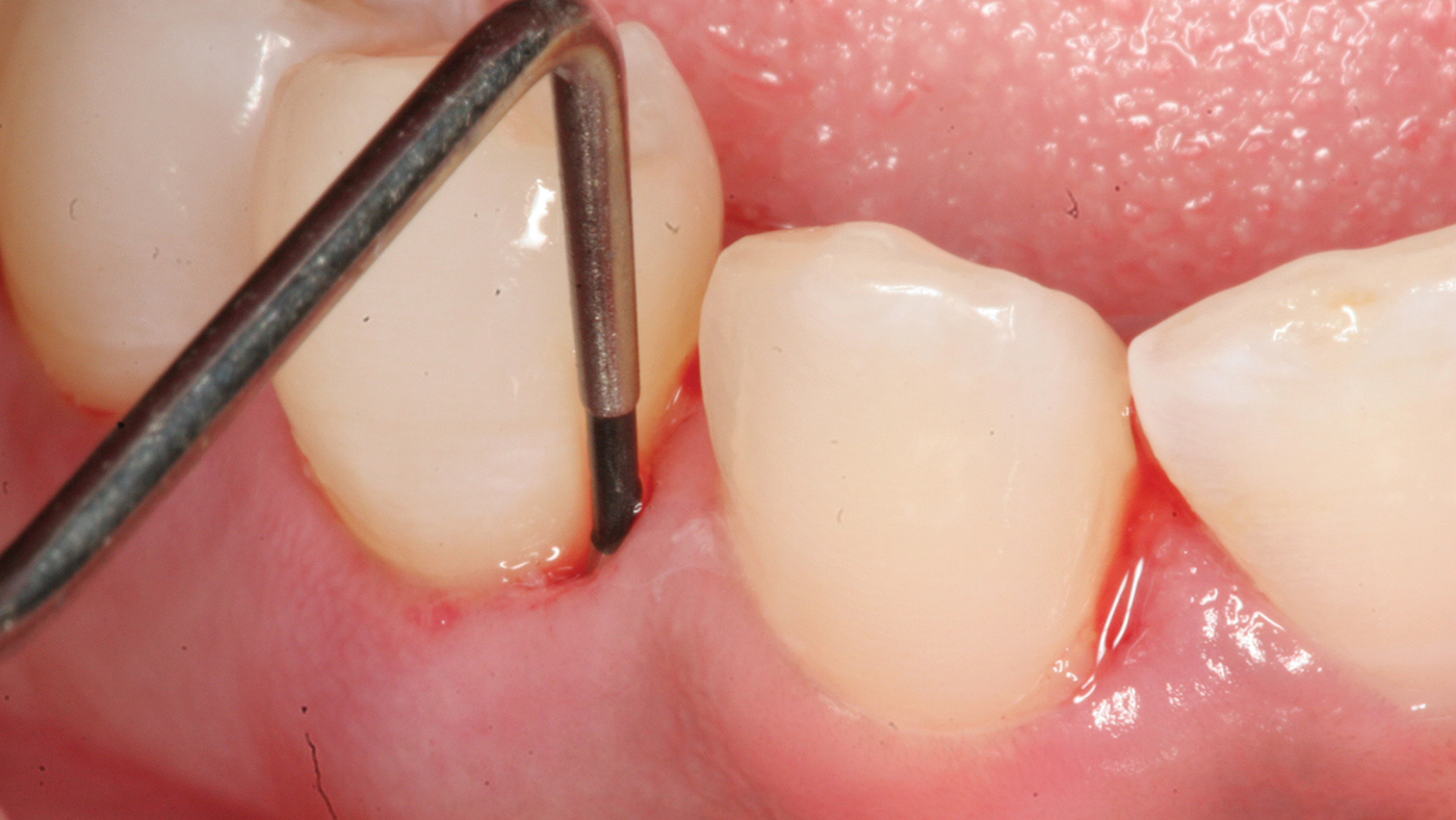 oral health dental care teeth gums bleeding gums periodontitis Gingivitis