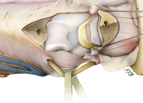 arm left arm olecranon olecranon osteotomy specimen dissection scientific illustration