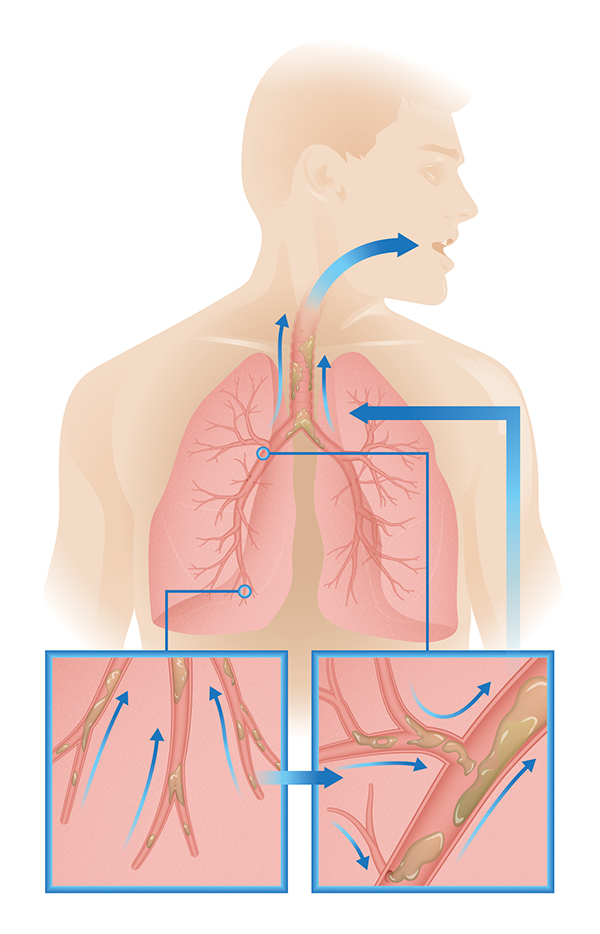 medical device medical illustration lungs mucus alveoli