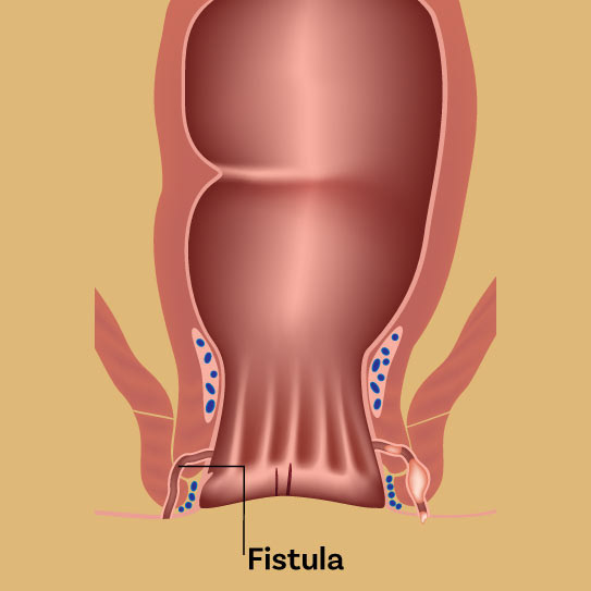 fistula surgery fistula surgery in jaipur