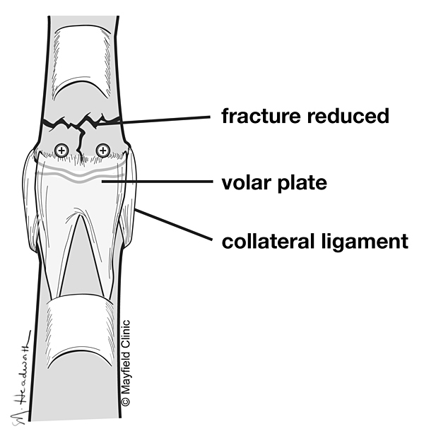 finger Fracture surgery anatomy bone tendon incision
