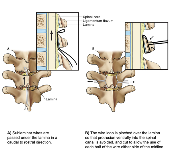 spine surgery anatomy thoracic wiring poster teaching surgeon