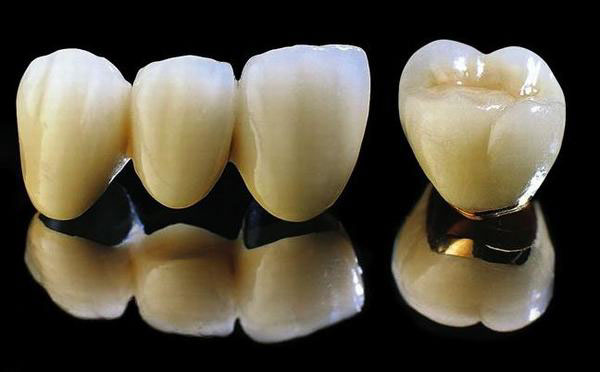 Răng sứ titan có thể được duy trì trên 10 năm