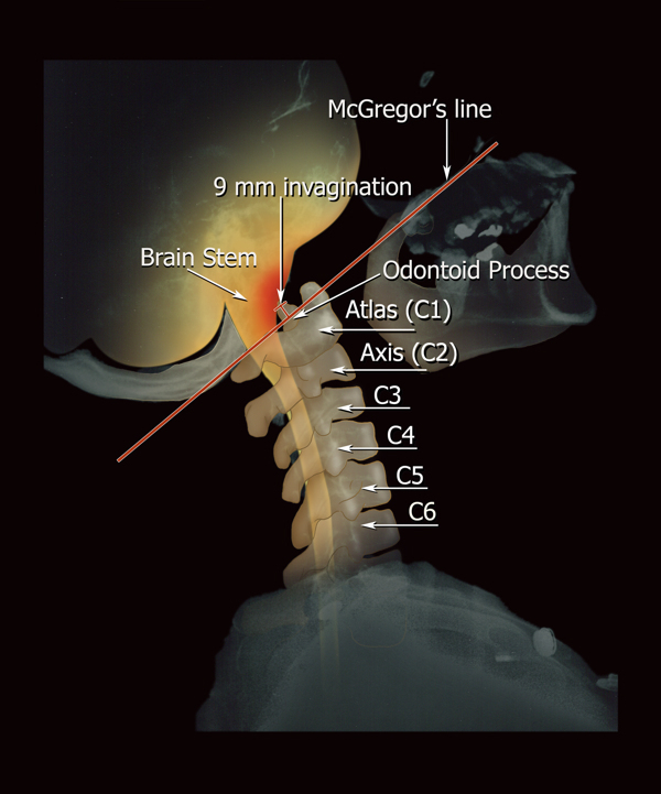 skull x-ray hip femur vertebre medicine malpractice Education Jury