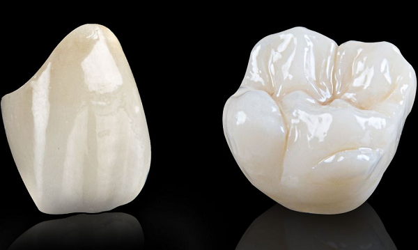 Răng toàn sứ Emax-Sự lựa chọn số 1 để bọc sứ cho răng