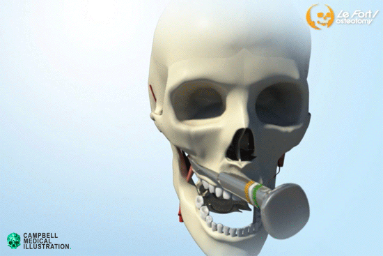 Surgical Animation for Education - Le Fort I Osteotomy on Behance