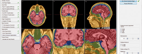 software digital EEG digital meg human brain activity Clinical Neurophysiology Clinical applications 3D imaging