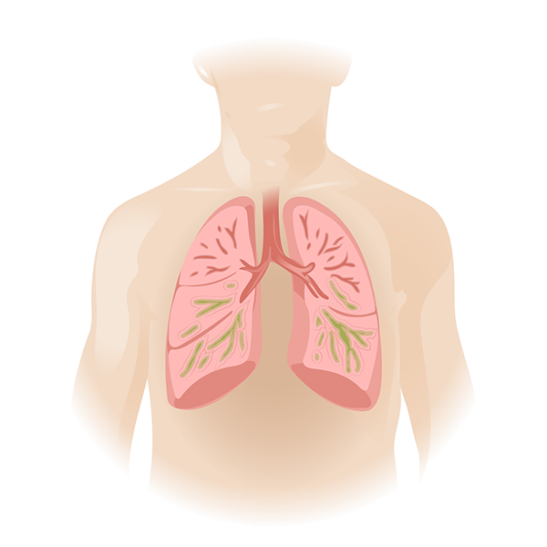 medical illustration bronchi mucus