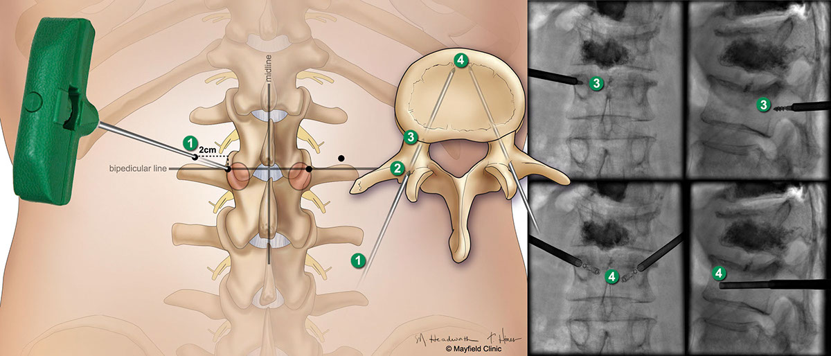 medical illustration spine surgery