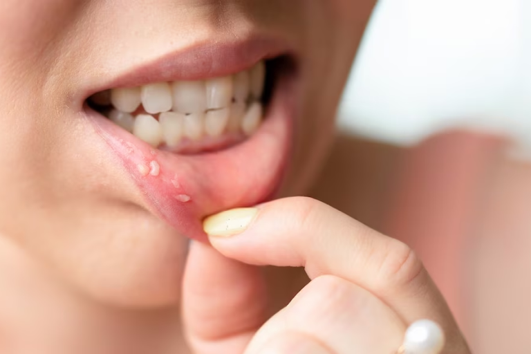 bumps pimple lips skincare Mouth Health dental dubai lipcare UAE
