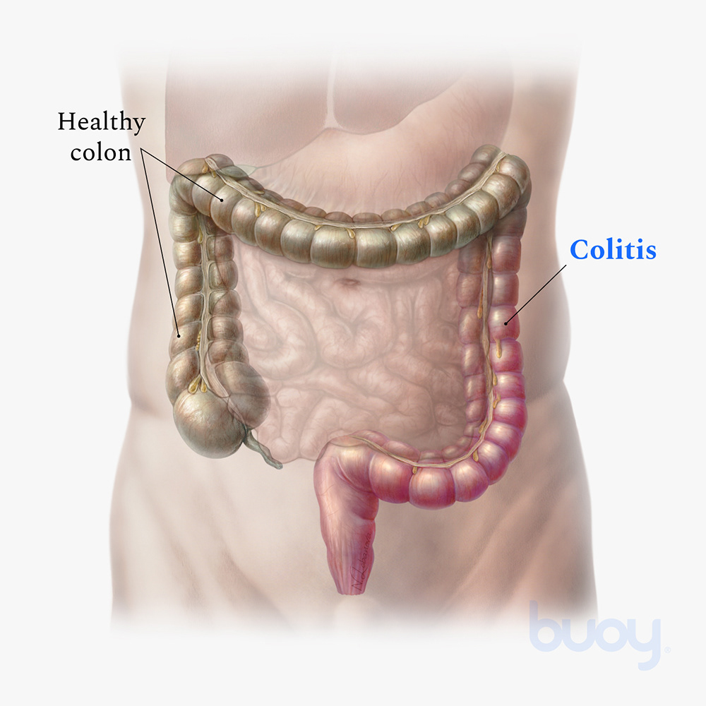 abdomen anatomy Colon Digestive Disease digital inflammation medical illustration pencil SciArt Ulcerative Colitis