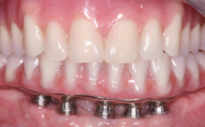 Dental Implants Dental implants dentist hcmc