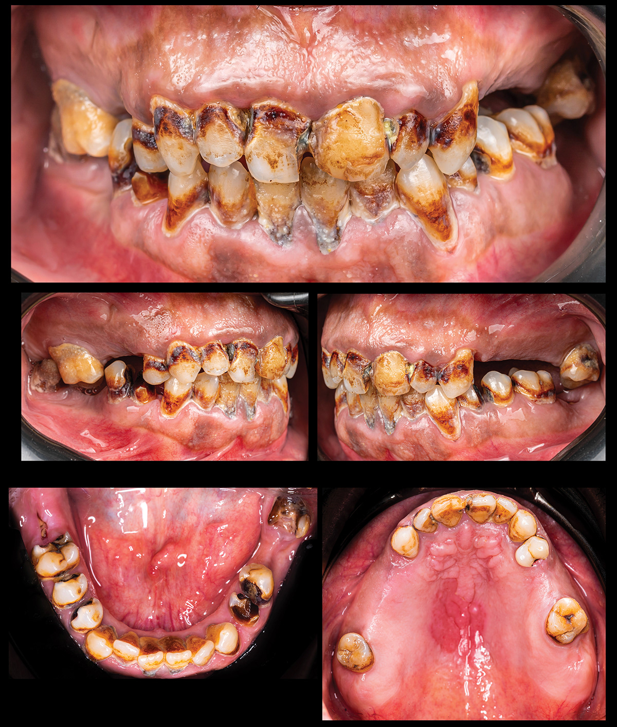 dentistry cosmetics Restorations Prosthesis dental crowns