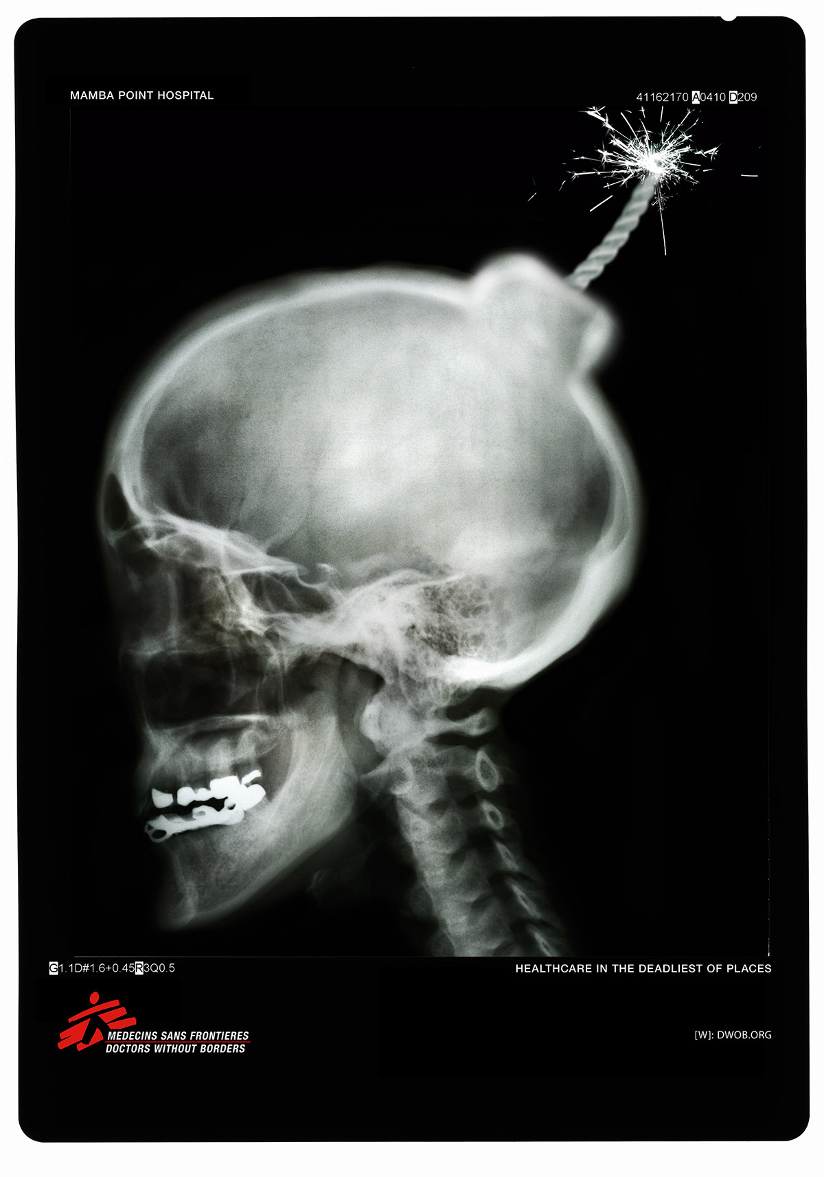 Bomb brain Bullet hand Pelvis grenade print photo x-ray