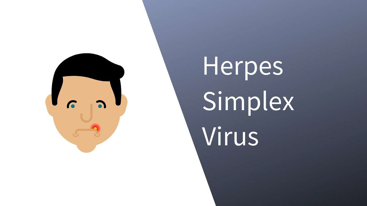 HERPES: CAUSES Symptoms And Treatment