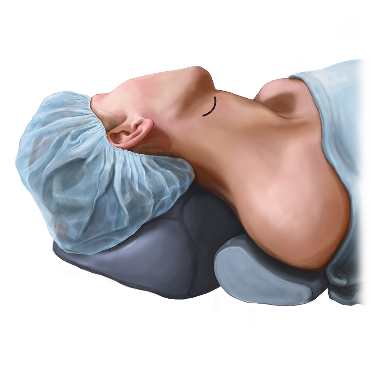 medical illustration Surgical Illustration submandibular gland removal