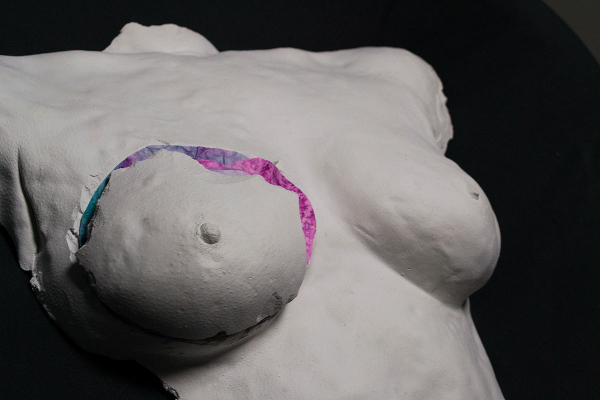 cancer Plâtre sculpture Moulage ablation reconstruction mammaire