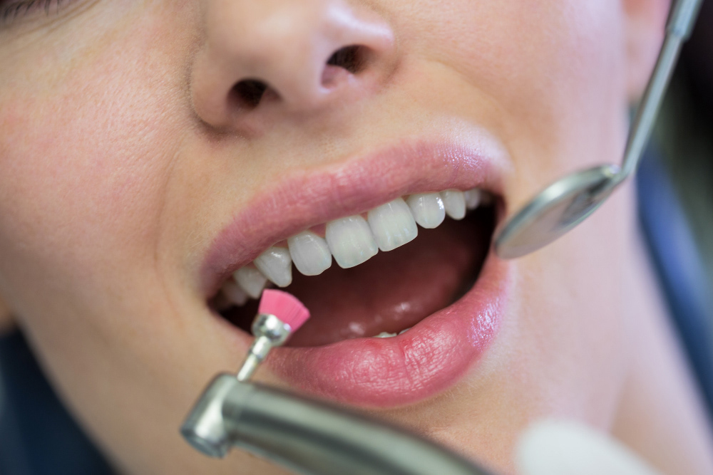 top-rated dental cleanings in Louisville