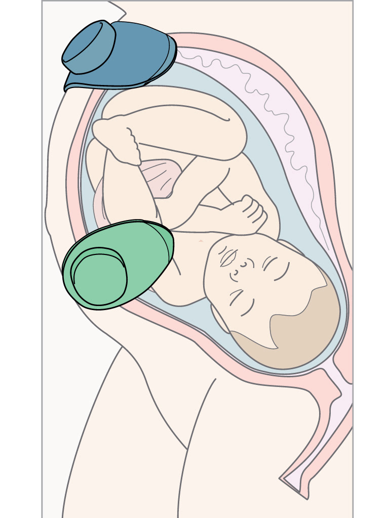 pregnant trasductor belly design