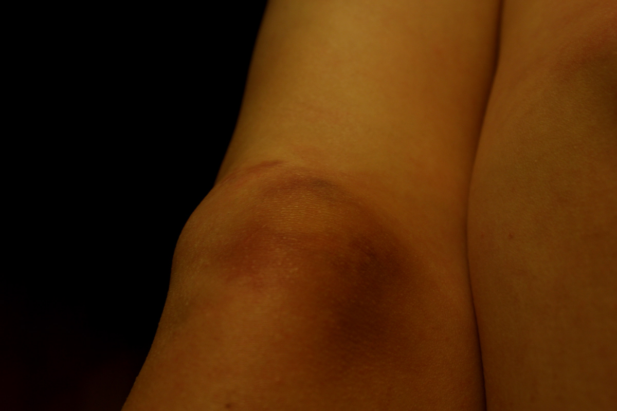 body Bruises
