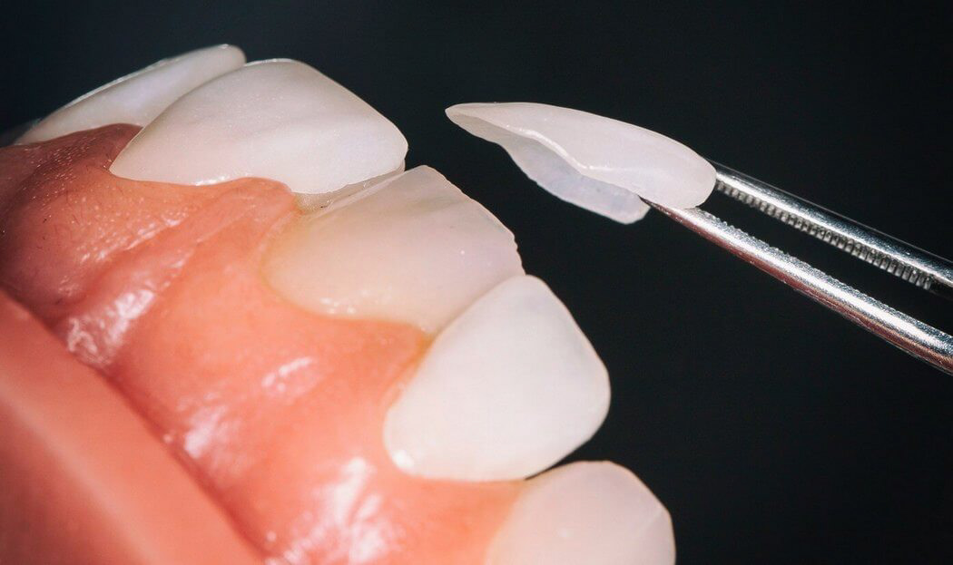 oral health dental care Dental Veneers