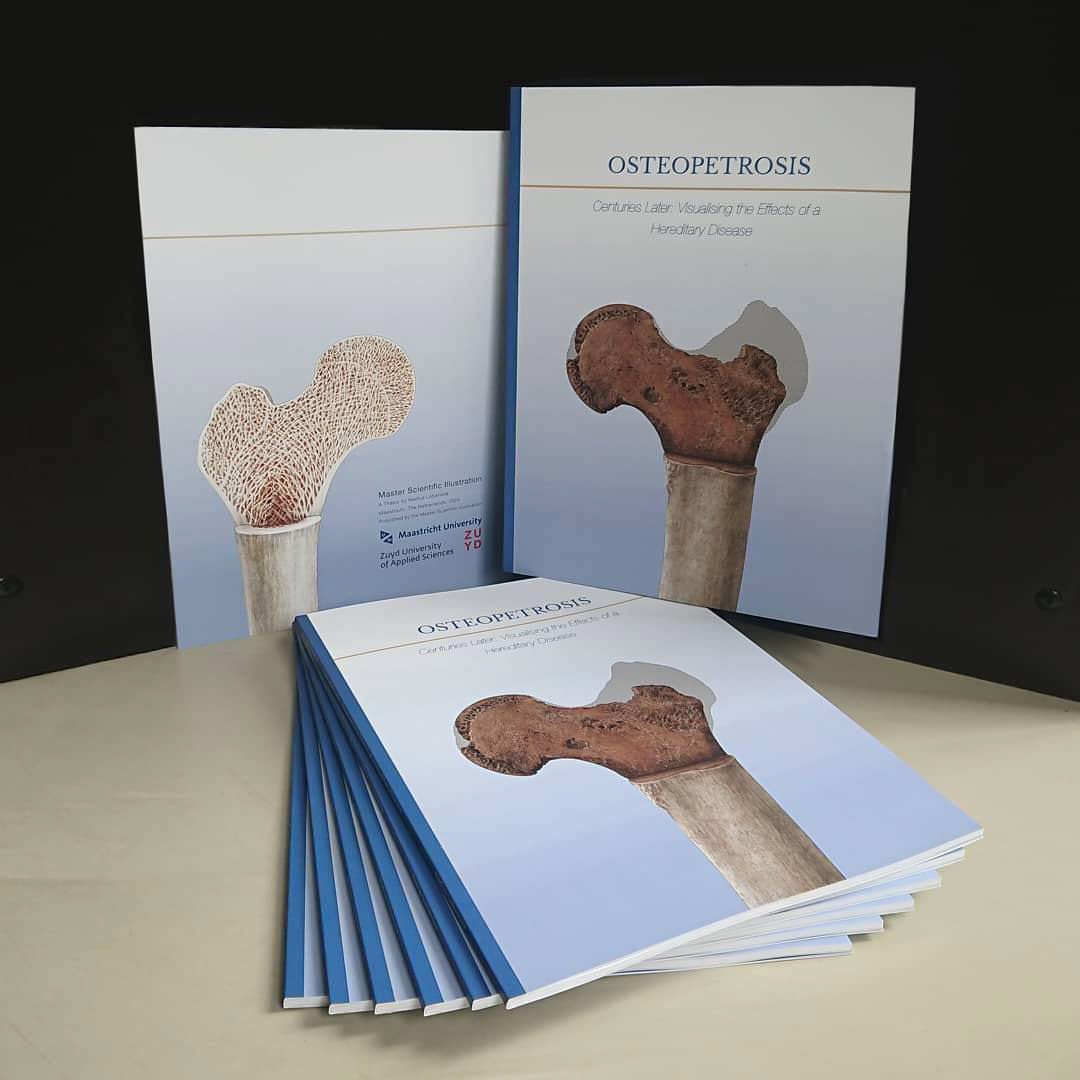 archaeology bone bonedisease book DigitalIllustration Disease human ILLUSTRATION  medicalillustration osteopetrosis