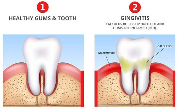 oral health dental care teeth gums bleeding gums periodontitis Gingivitis