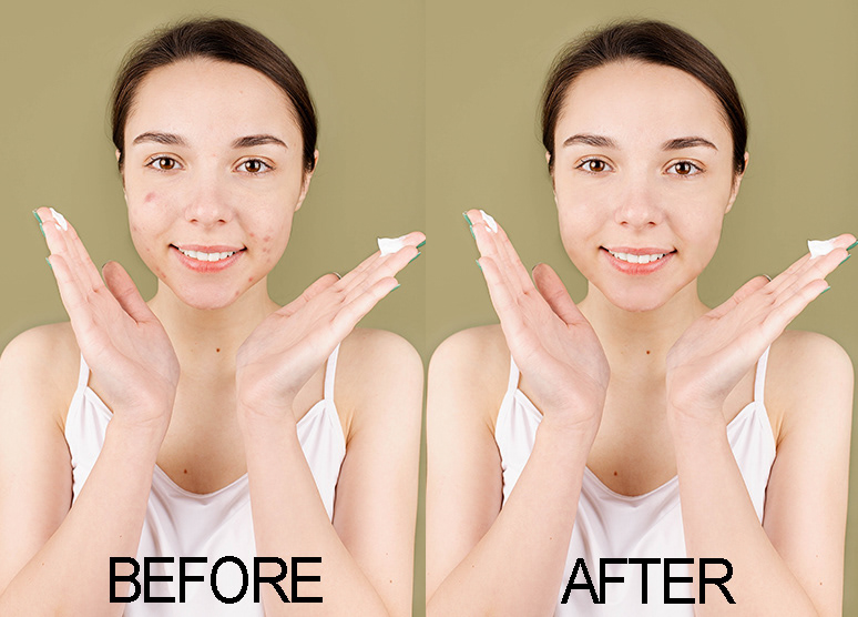ACNE FACE RETOUCH acne removal acne face wash Acne Treatment photoshop