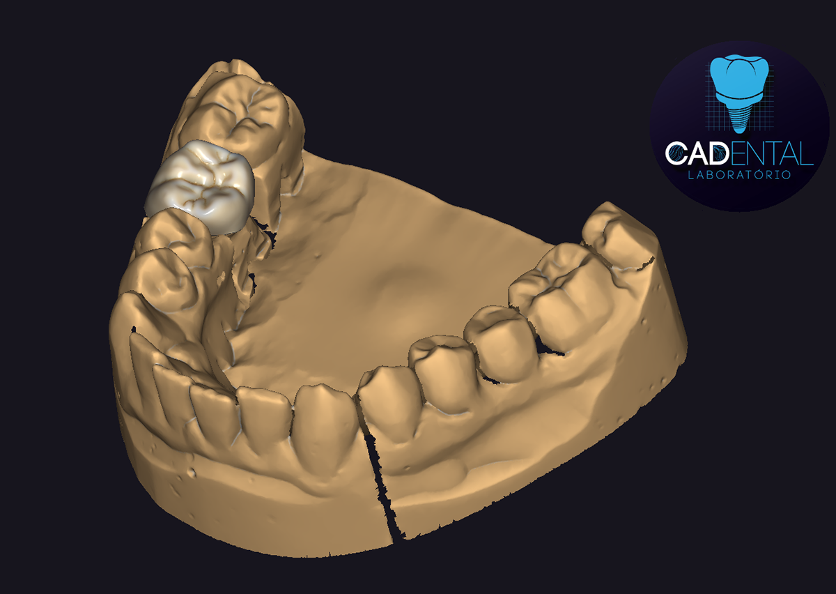 exocad dental dentist teeth dental clinic 3D 3Dprinter cad