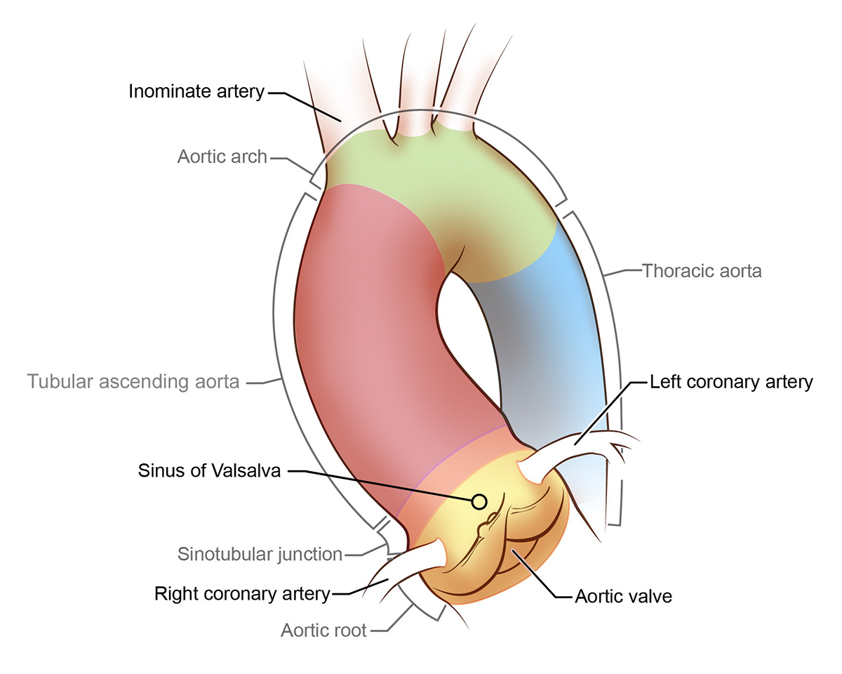 Bicuspid Aortic Valve and aortic aneurysm on Behance