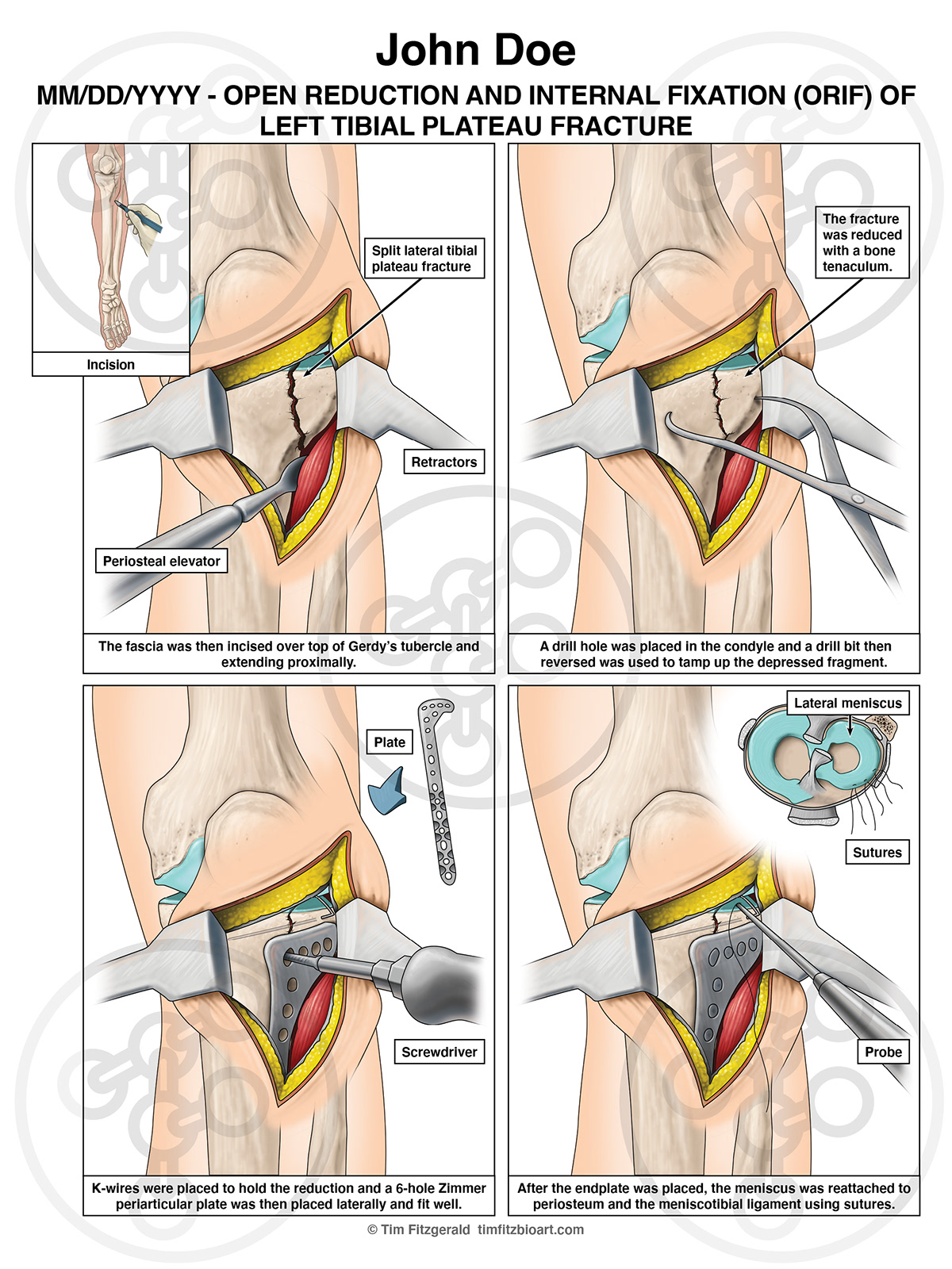 Fracture knee Litigation graphics medical illustration medical legal art personal injury SciArt surgery Surgical Illustration trial graphics