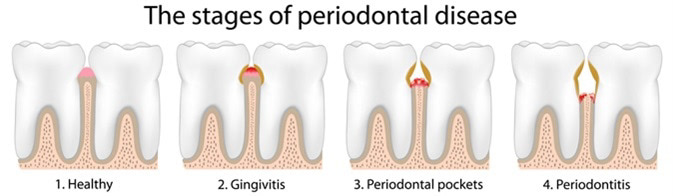 oral health dental care teeth gums cardiovascular disorder