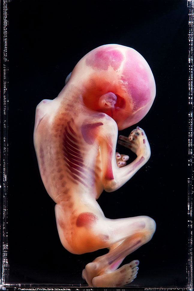 fetus stillborn baby Disease congenital disease portrait